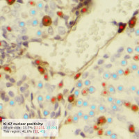 The explainability paradox: Challenges for xAI in digital pathology 